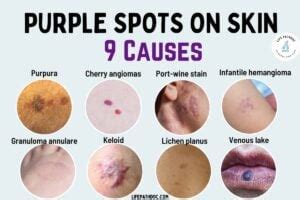 Purple Spots on Skin: 9 Causes, Pictures, and Treatment