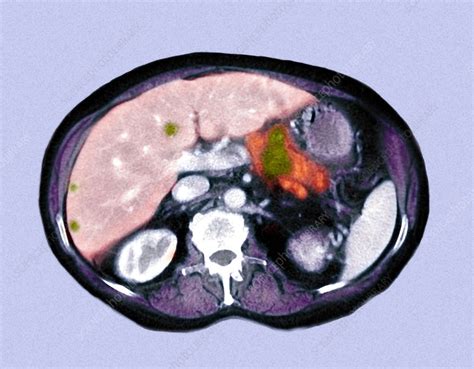 Metastatic pancreatic cancer, CT scan - Stock Image - M134/0536 ...