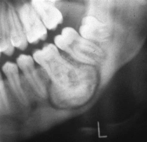 Dentaltown - Cementoblastoma on 18?? Cementoblastoma on 18?? Dentaltown Message Board Oral ...