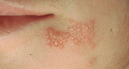 Herpes simplex: Foothill Dermatology Medical Center: Dermatology