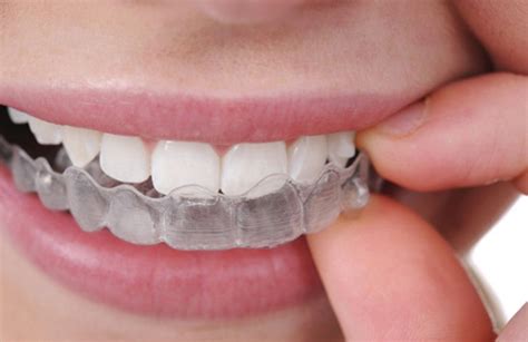 Invisalign Clear Aligners - Phillip Dental Implant & Cosmetic Center