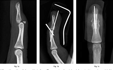 Figure 1 from Two extension block Kirschner wire technique for mallet finger fractures ...