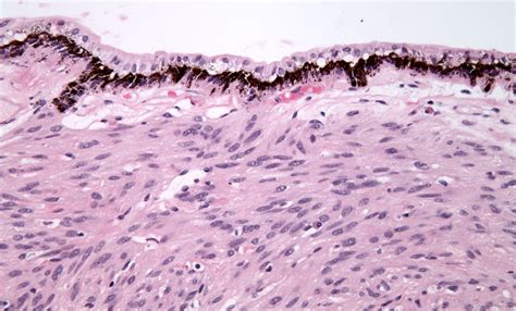 Clinicopathologic Correlation: Ciliary Body Leiomyoma. EyeRounds.org ...