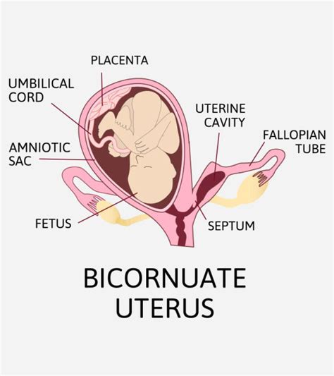 Bicornuate Uterus: Symptoms, Causes, Diagnosis, And Treatment