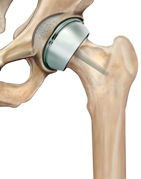 Hip Resurfacing - Dr. Anthony Spriggins