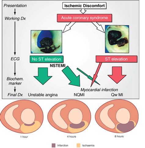 MBBS Medicine (Humanity First): What is the difference between NSTEMI ...