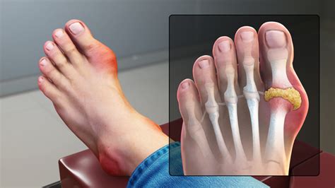 Gout in big toe: How to identify, causes, and treatment