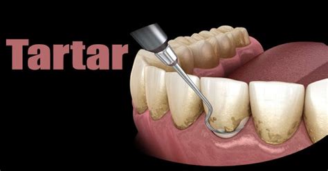 Tartar: Understanding the Causes, Prevention, and Treatment