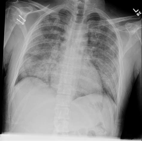 Electronic-Cigarette or Vaping Associated Lung Injury (EVALI) • APPLIED ...