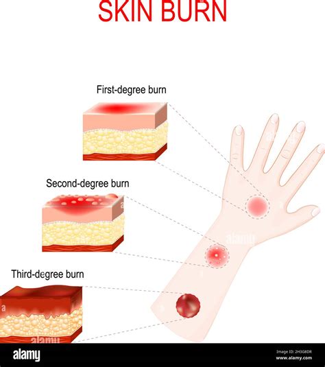 Difference Between 1st 2nd And 3rd Degree Burns