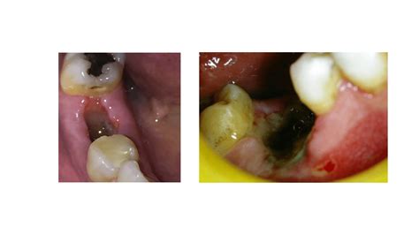 What does a blood clot after tooth extraction look like? Preventing dislodgment