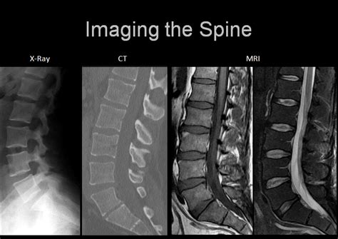 Will an MRI show a bulging disc? - Health Blog