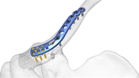 Clavicle Plating System | Acumed