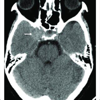 NCCT head axial section showing the right cavernous hyperdense mass... | Download Scientific Diagram