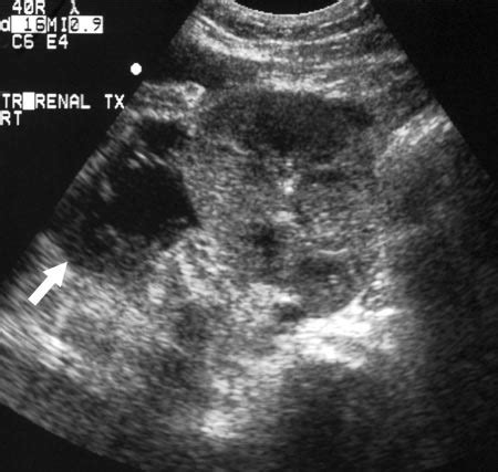 Perinephric abscess. US image demonstrates a loculated perinephric ...