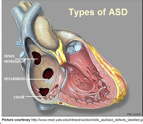 Atrial Septal Defect | Atrial septal defect, Cardiac sonography, Cardiac nursing