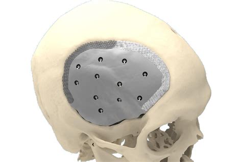 CRANIOPLASTY - Patient concept | CADskills