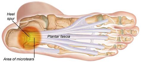 Plantarfasciitis - What the Heel?