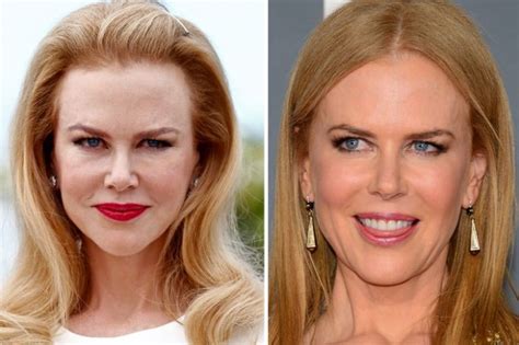 nicole kidman botox – TheCount.com