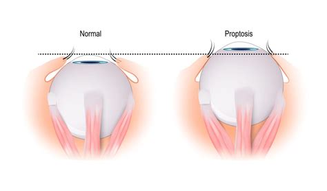 Proptosis Symptoms and Treatment - Clinique VisionPros