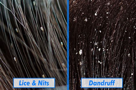 What is the Difference Between Lice and Dandruff - Differences Finder