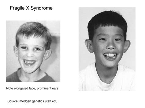 PPT - Fragile X Syndrome PowerPoint Presentation, free download - ID:340016