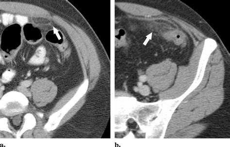 Epiploic Appendages