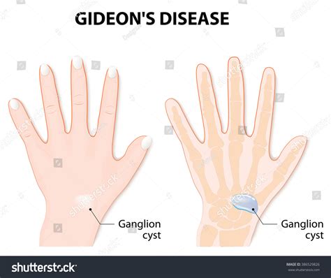 Ganglion Cyst Known Synovial Cyst Gideons: ilustrações stock 386529826 | Shutterstock