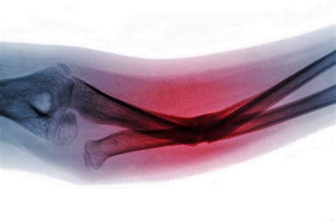 Bone Fracture - Closed Reduction and Internal Fixation