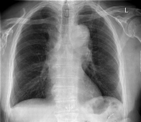 A rare cause for superior vena cava obstruction | BMJ Case Reports