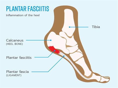 Plantar Fasciitis - Nova Physiotherapy