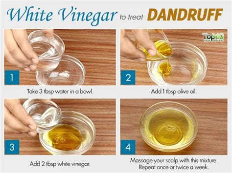 Home Remedies for Dandruff | Top 10 Home Remedies