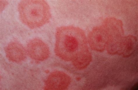 Erythema Multiforme: Causes, Symptoms, Treatment, Complications and Outlook - Scope Heal