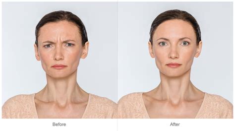 BOTOX Filler Cosmetic Dermatology | Advanced Dermatology of Midlands