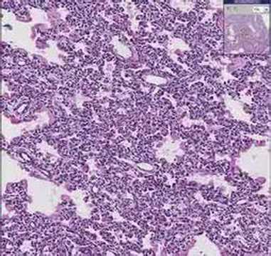 Histopathology Lung--Hyaline membrane disease - YouTube