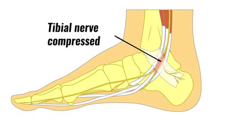 Tarsal Tunnel Syndrome - Symptoms, Causes, Treatment & Exercises