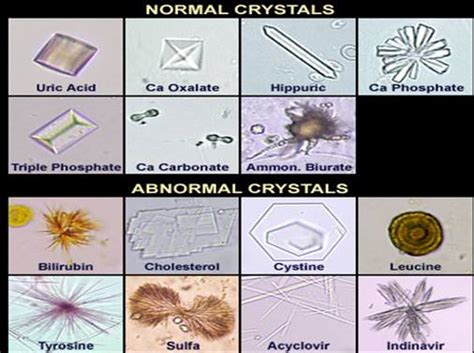 Types of Crystals in Urine