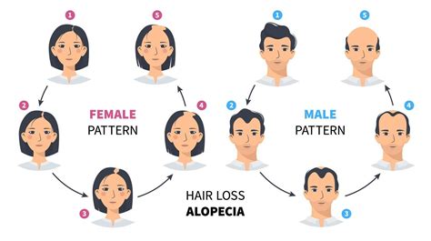 Hair loss stages, androgenetic alopecia male and female pattern. Steps of baldness vector circle ...