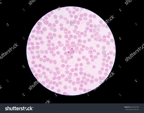 Giant Platelet Disorders Rare Disorders Featuring Stock Photo 356302784 ...