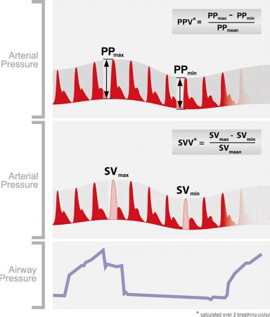 Fluid responsiveness – Pocket ICU