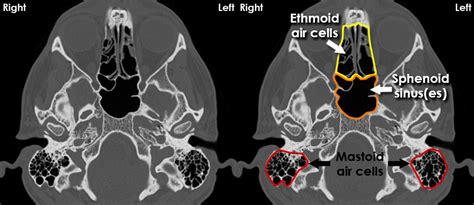 Frontal Sinus CT Scan