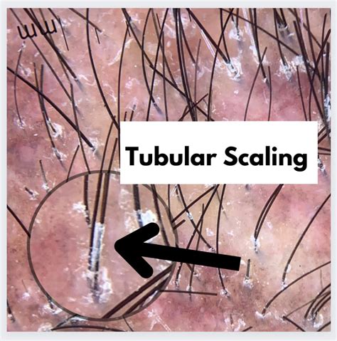 Tubular Scaling in Lichen Planopilaris (LPP) — Donovan Hair Clinic