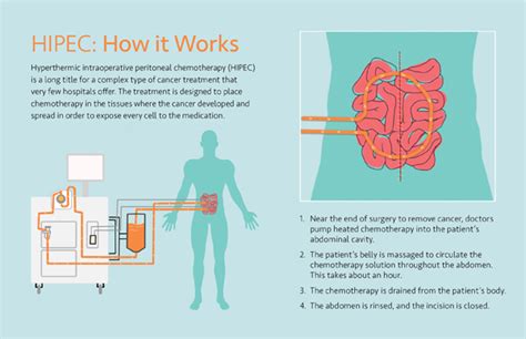 How HIPEC improved a cancer patient’s odds | UCI Health | Orange County, CA