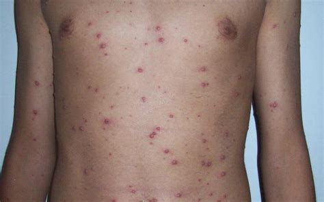 The Chicken Pox Vaccine . . . . the Facts! | Kalmed Clinic