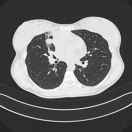 Hilum overlay sign - mediastinal lymphoma | Image | Radiopaedia.org