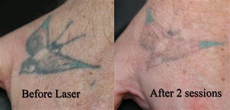 Laser Tattoo Removal « Eternal-Art