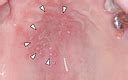 Cureus | Oral Herpes Zoster Infection Following COVID-19 Vaccination: A Report of Five Cases