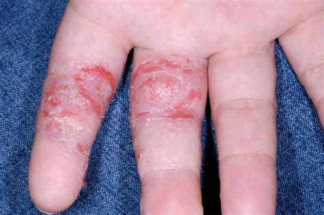 Dyshidrotic Eczema Finger Tips at Helen Breen blog