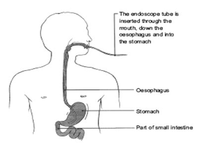 Combined Upper GI Endoscopy and Colonoscopy | Hull University Teaching ...