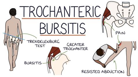 Understanding Trochanteric Bursitis - YouTube